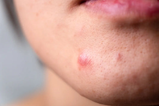 Using DMSO to Eliminate Acne